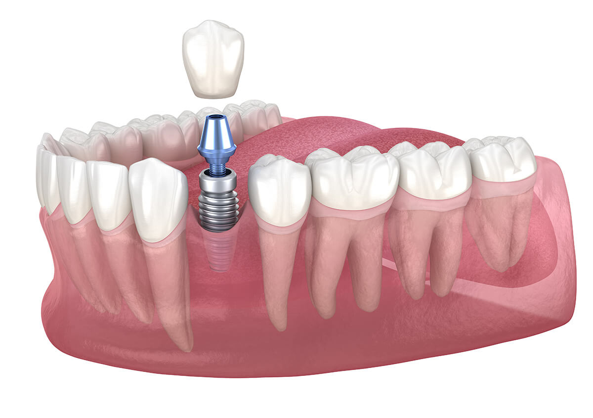 Dental Implant Surgery in West Linn OR Area